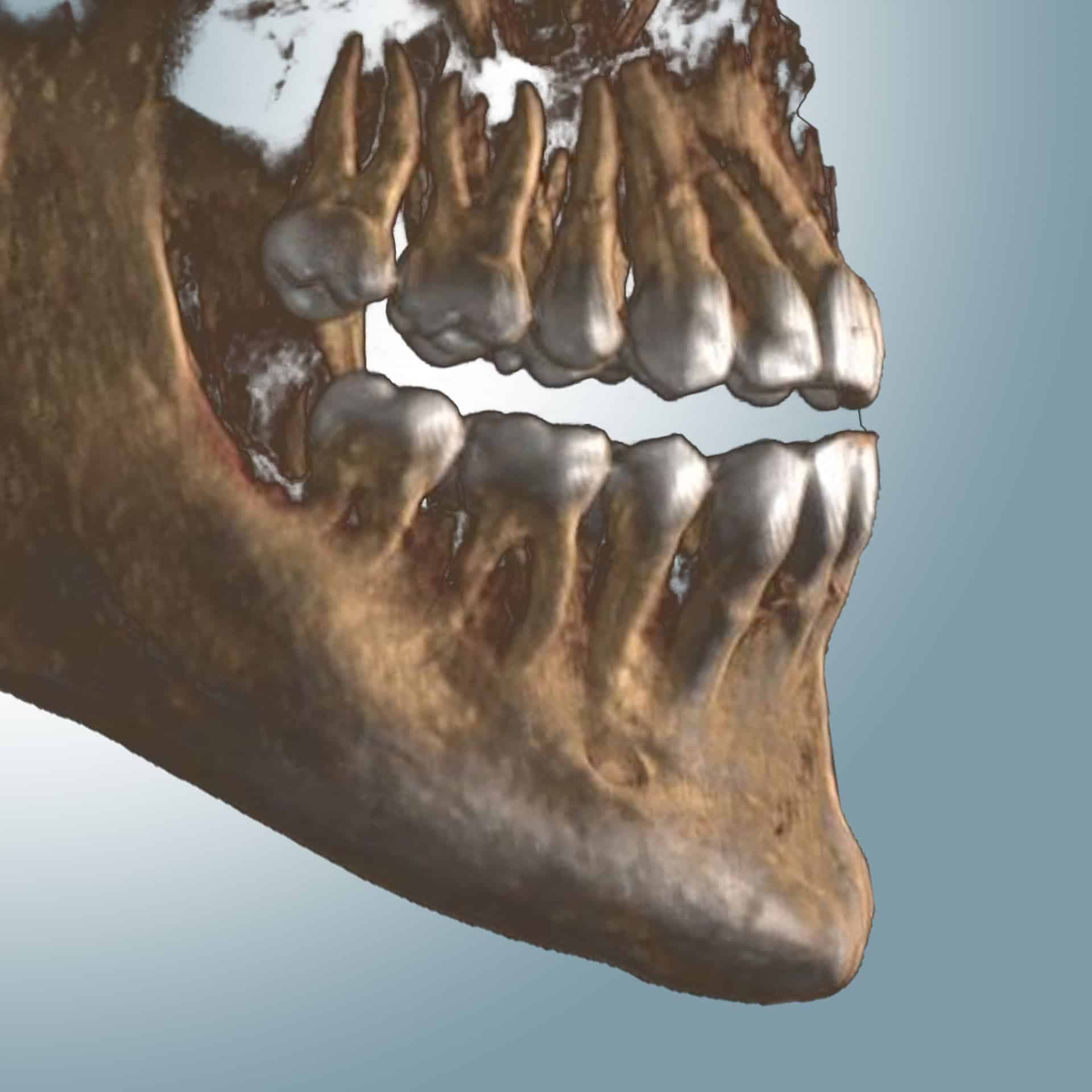 CBCT Dental Scan