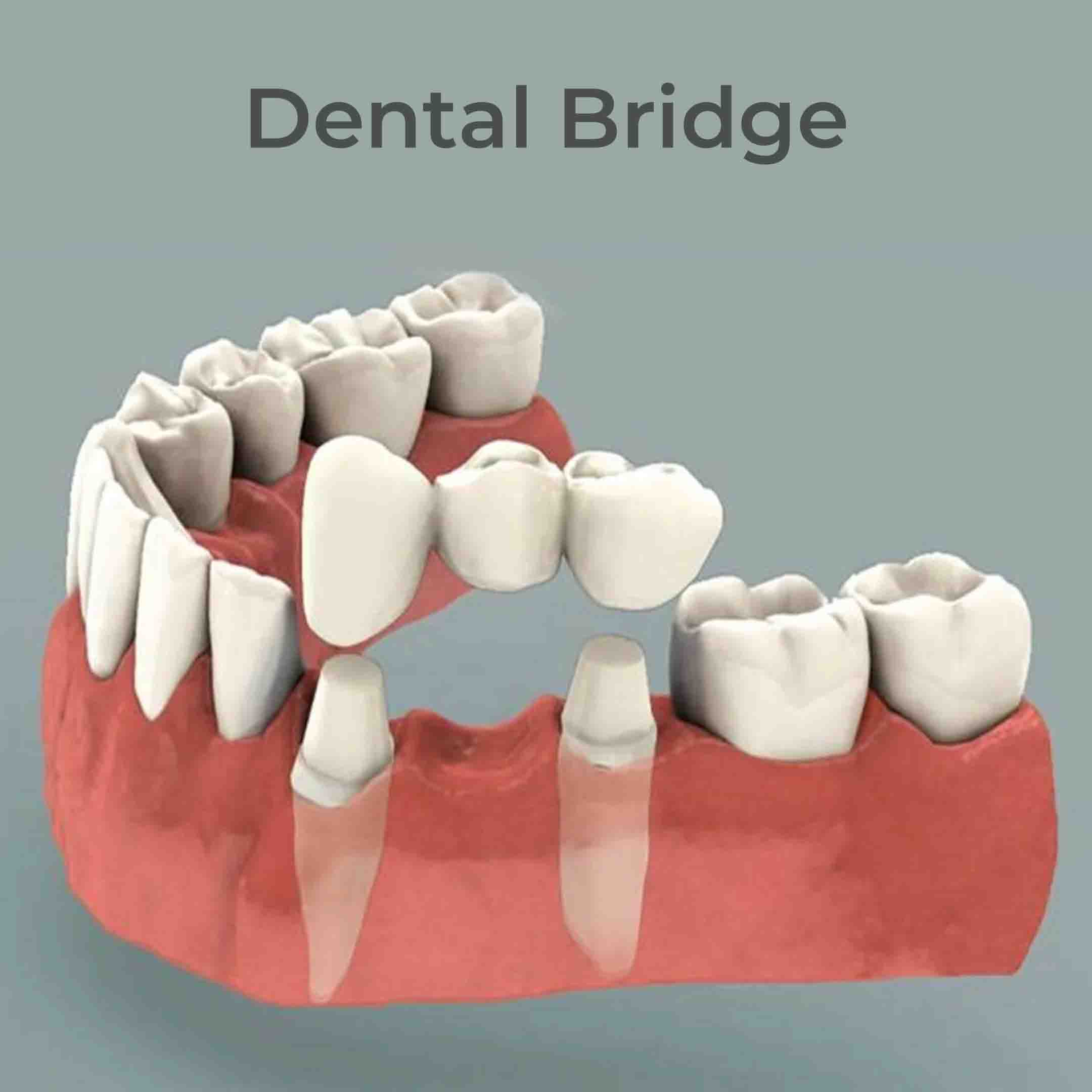 what is a bridge for dental