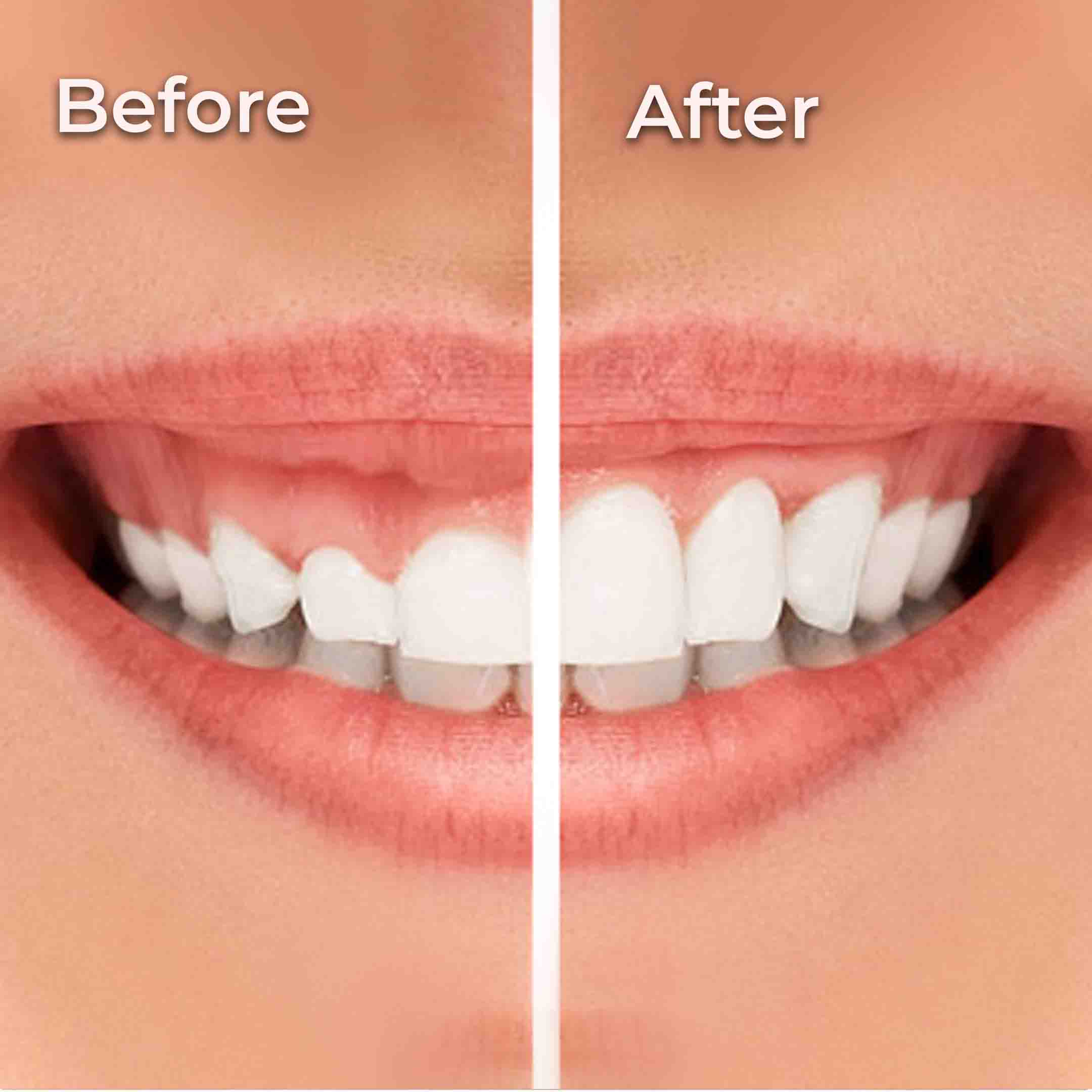 Gum Recontouring Before and After
