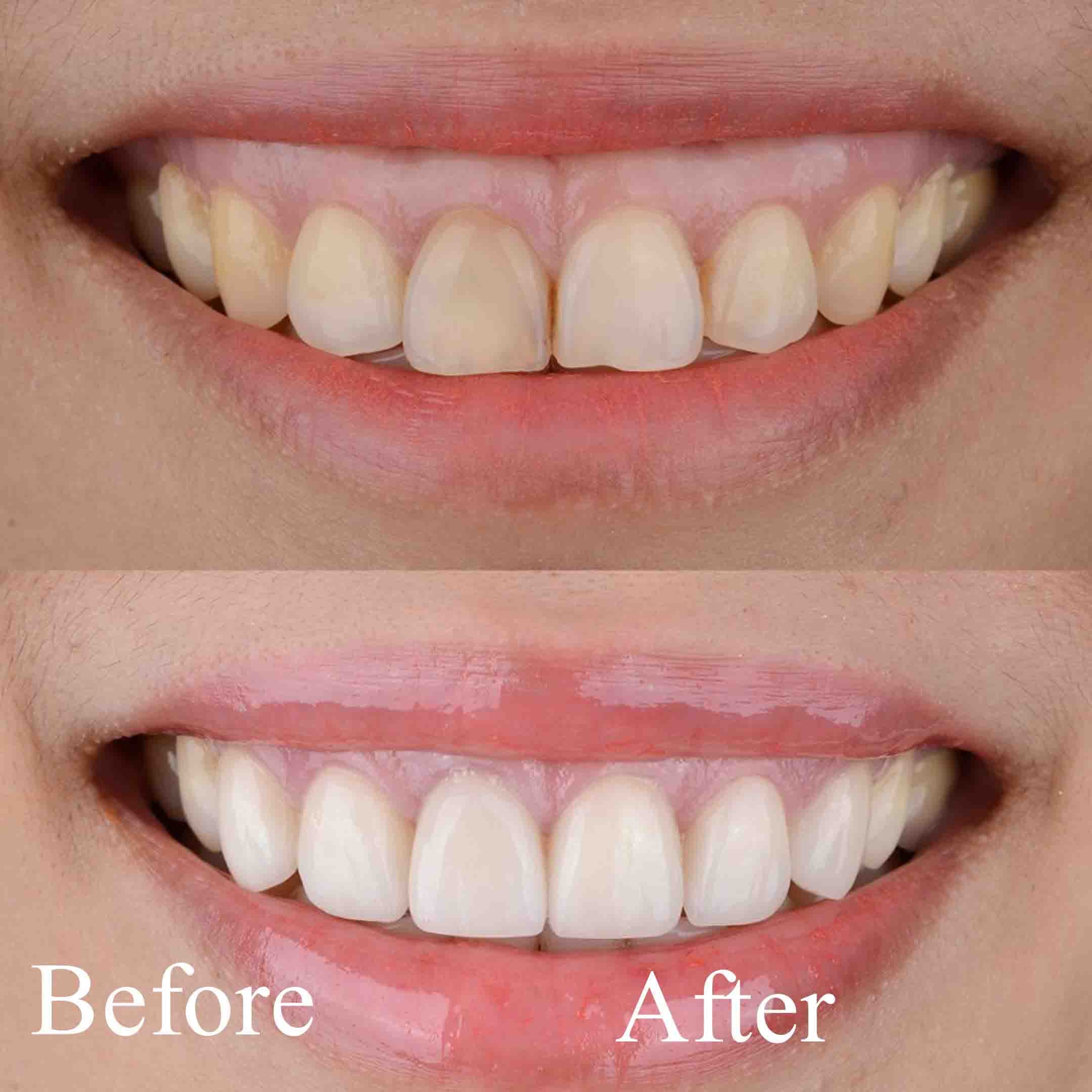 gum laser treatment before and after