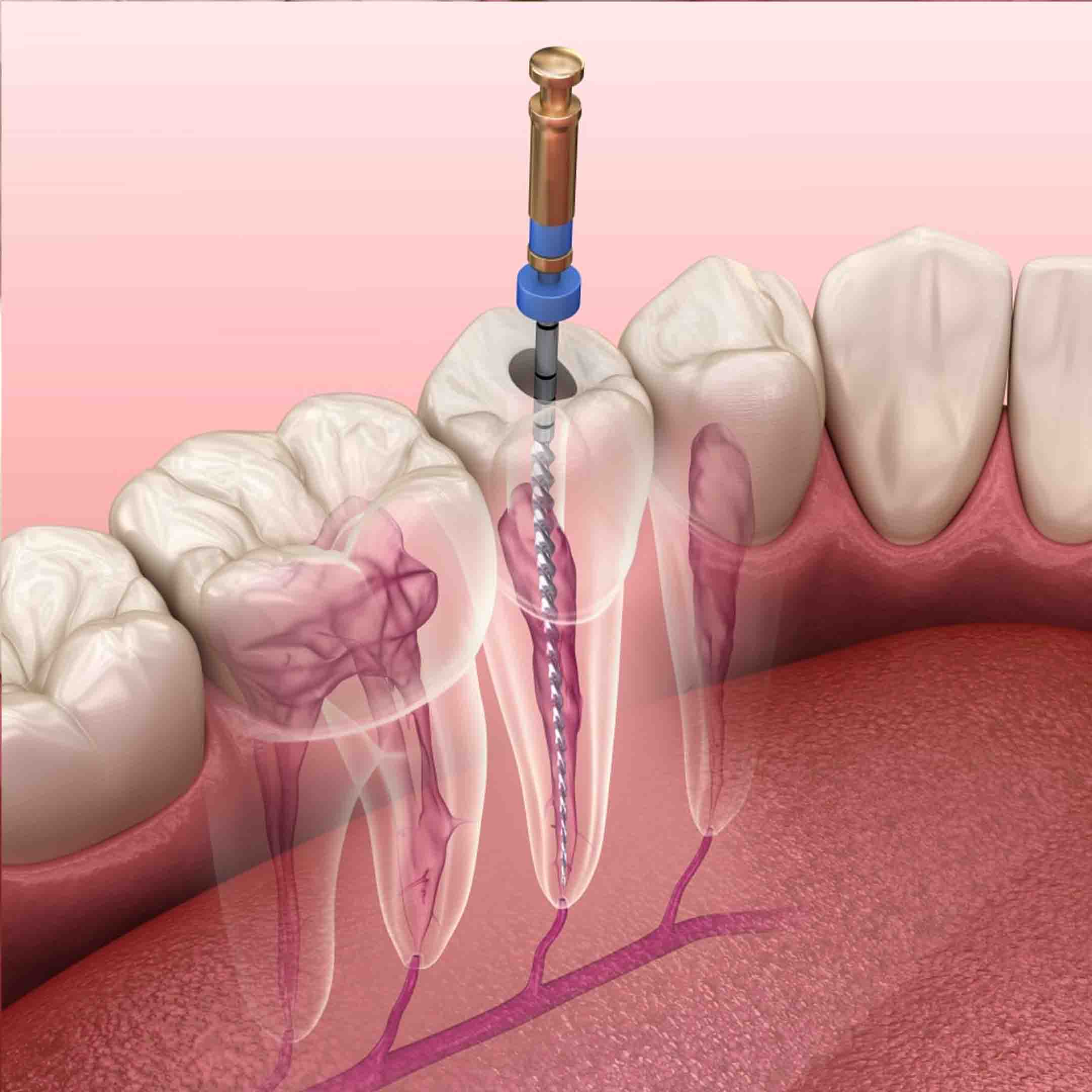 what's a root canal