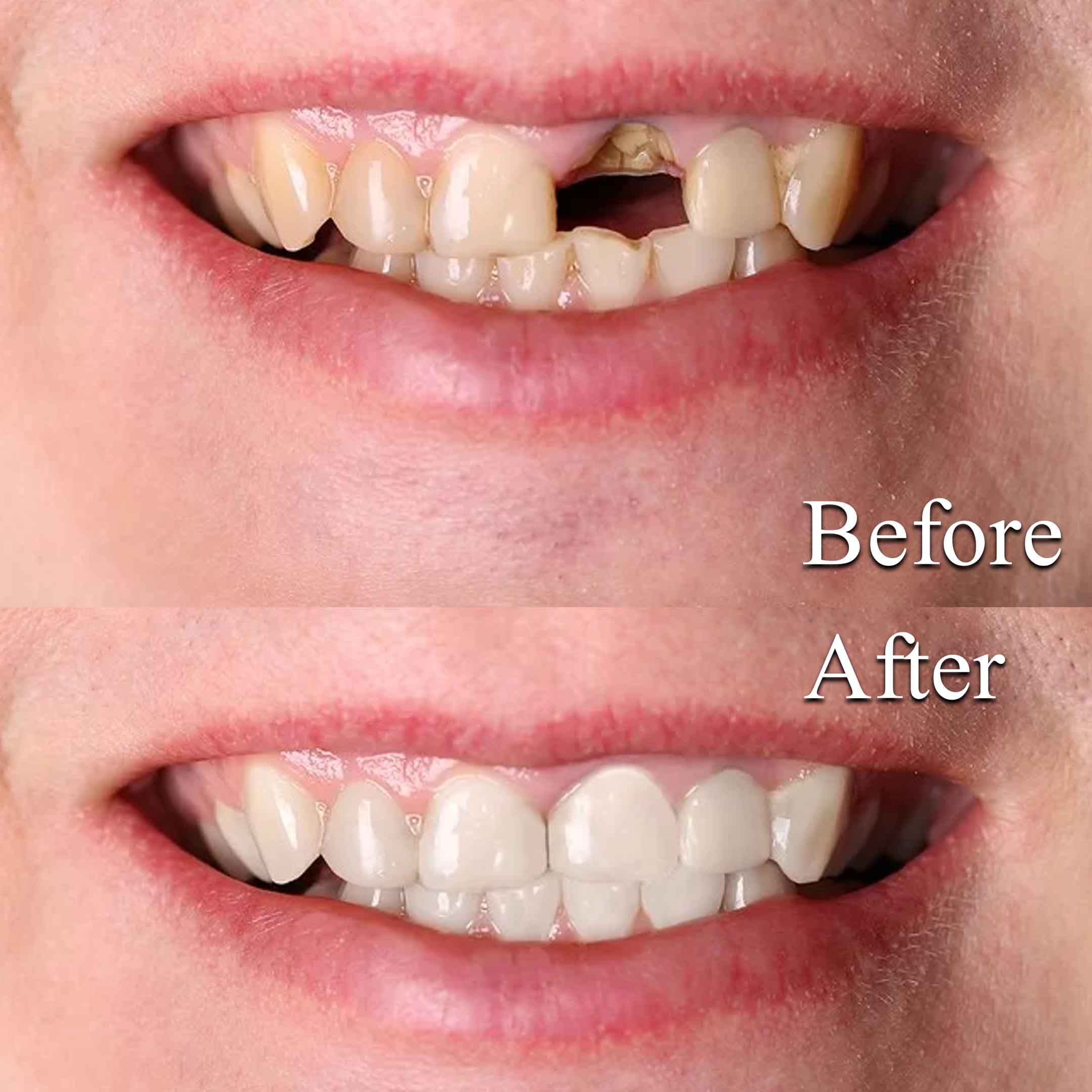 Tooth Extraction Before and After