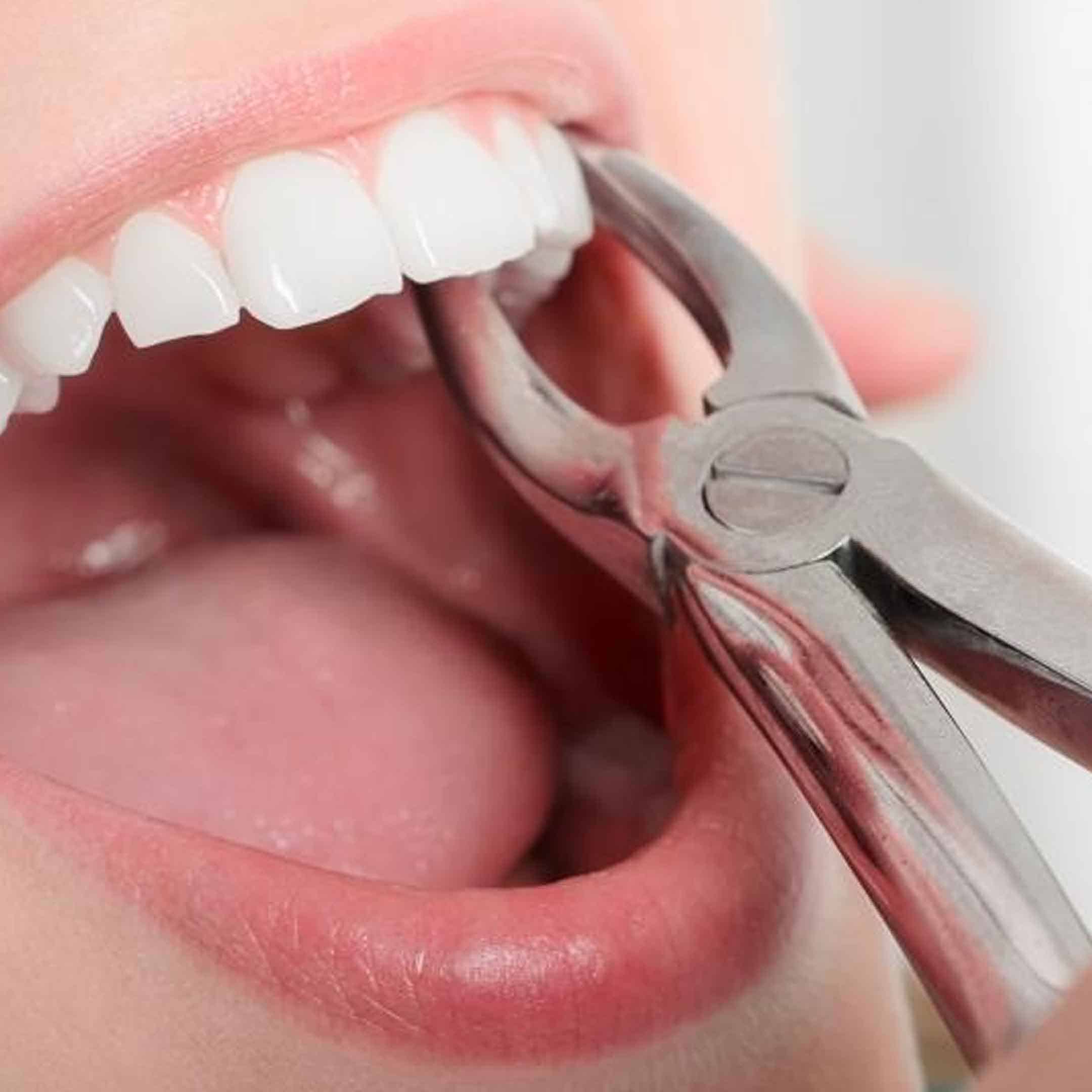 what is the meaning of tooth extraction?