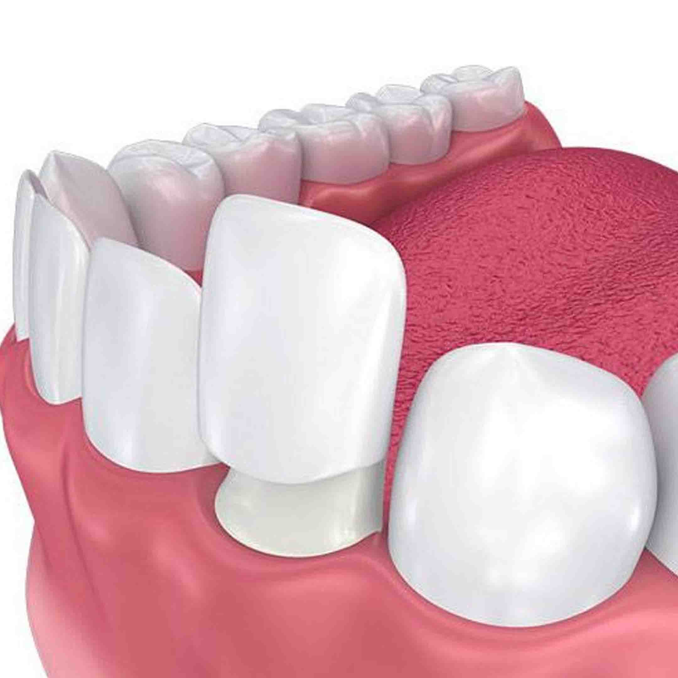 dental bondings