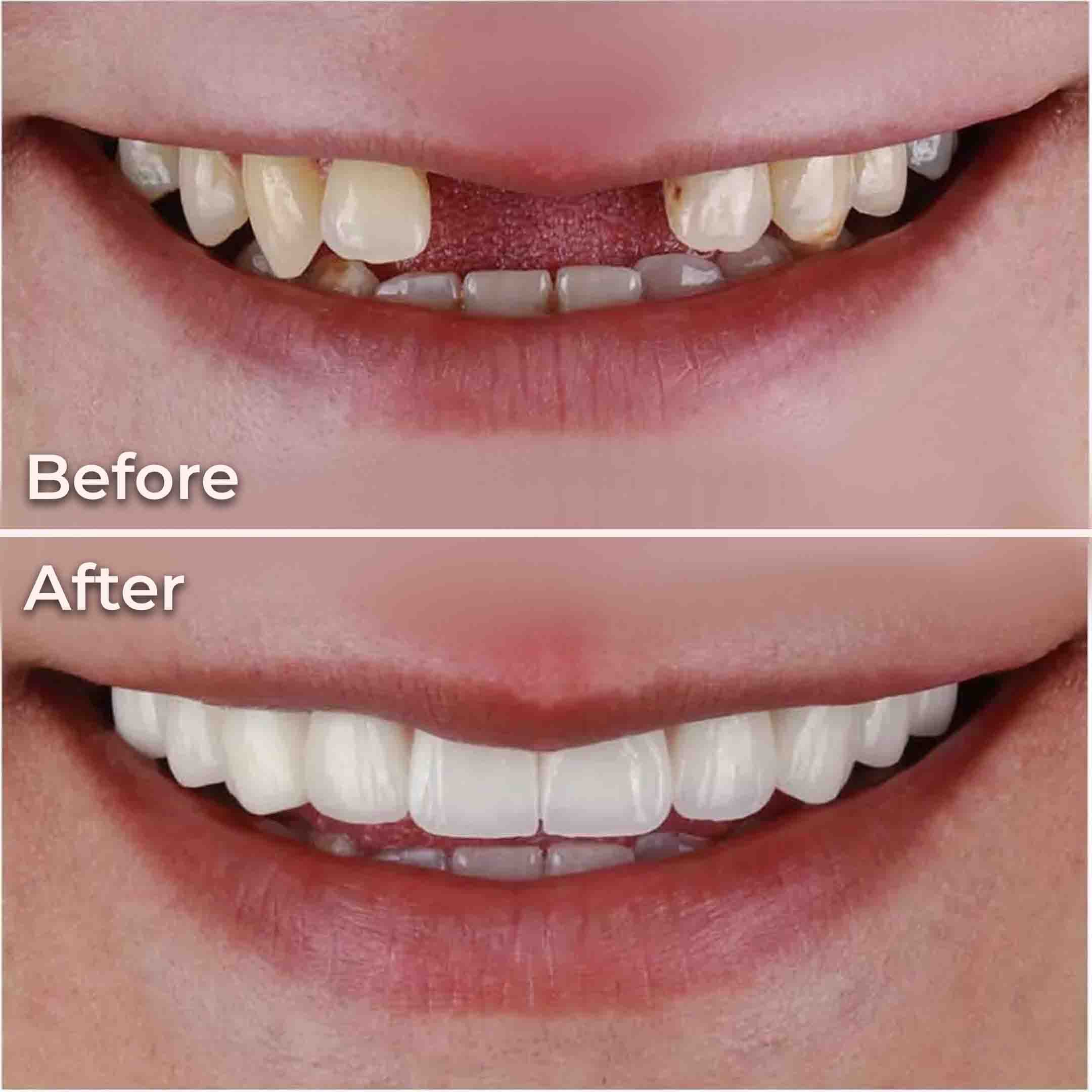 dental bridge before and after