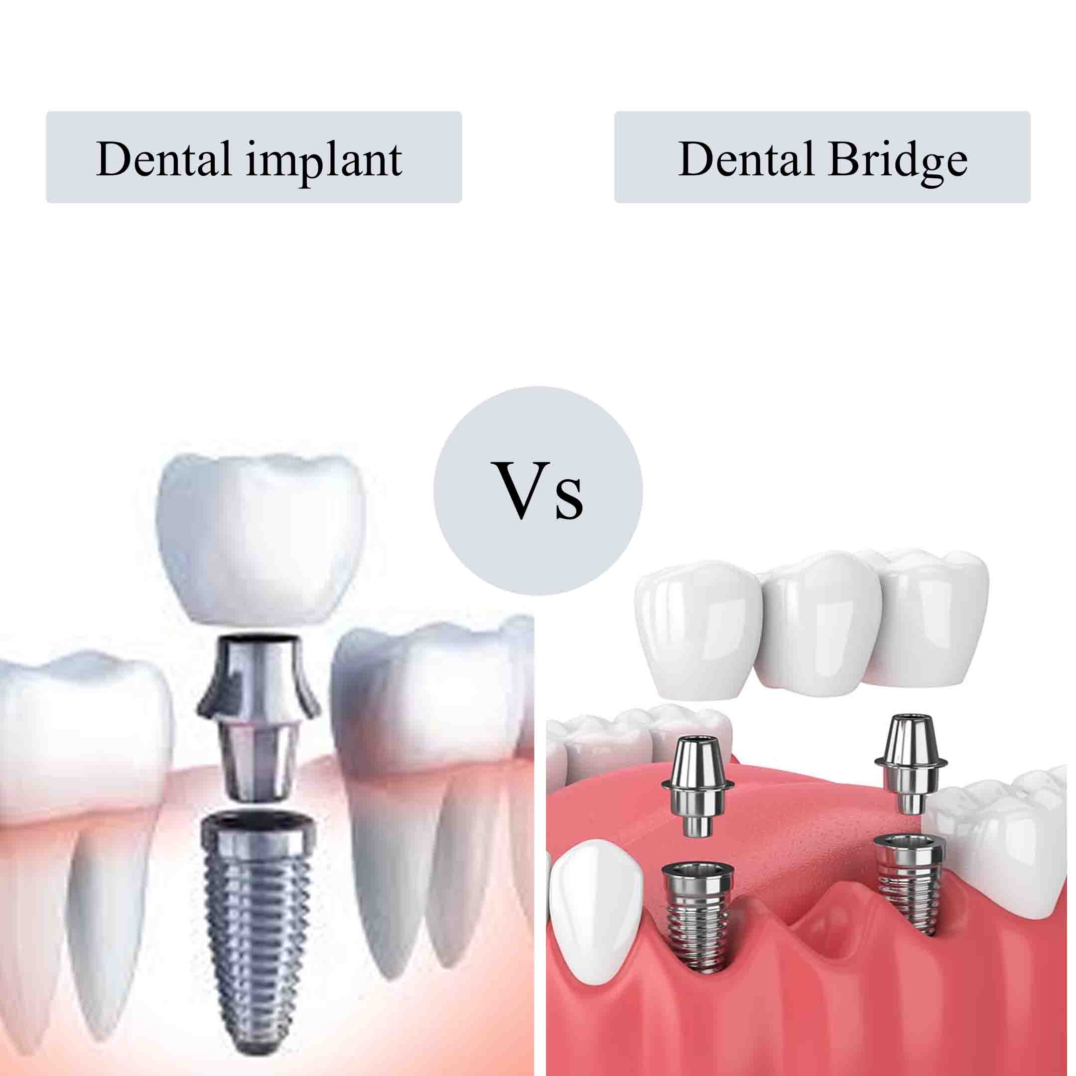 dental implant bridge
