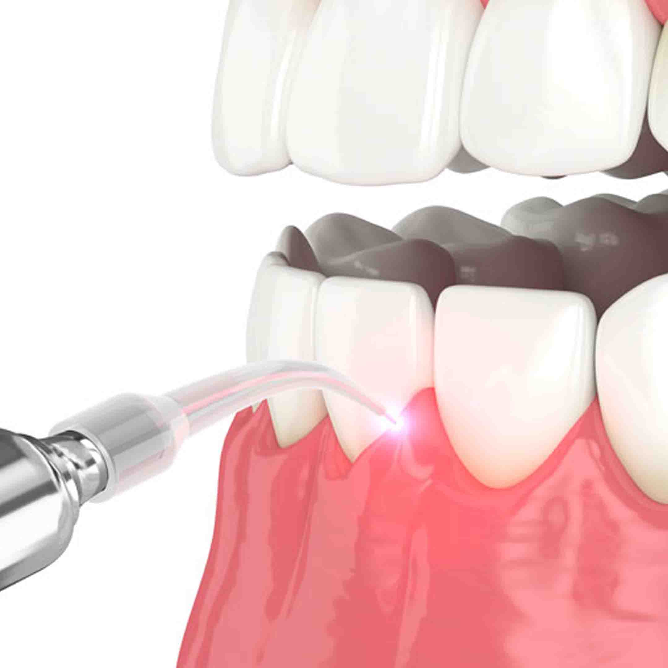 laser for periodontal disease