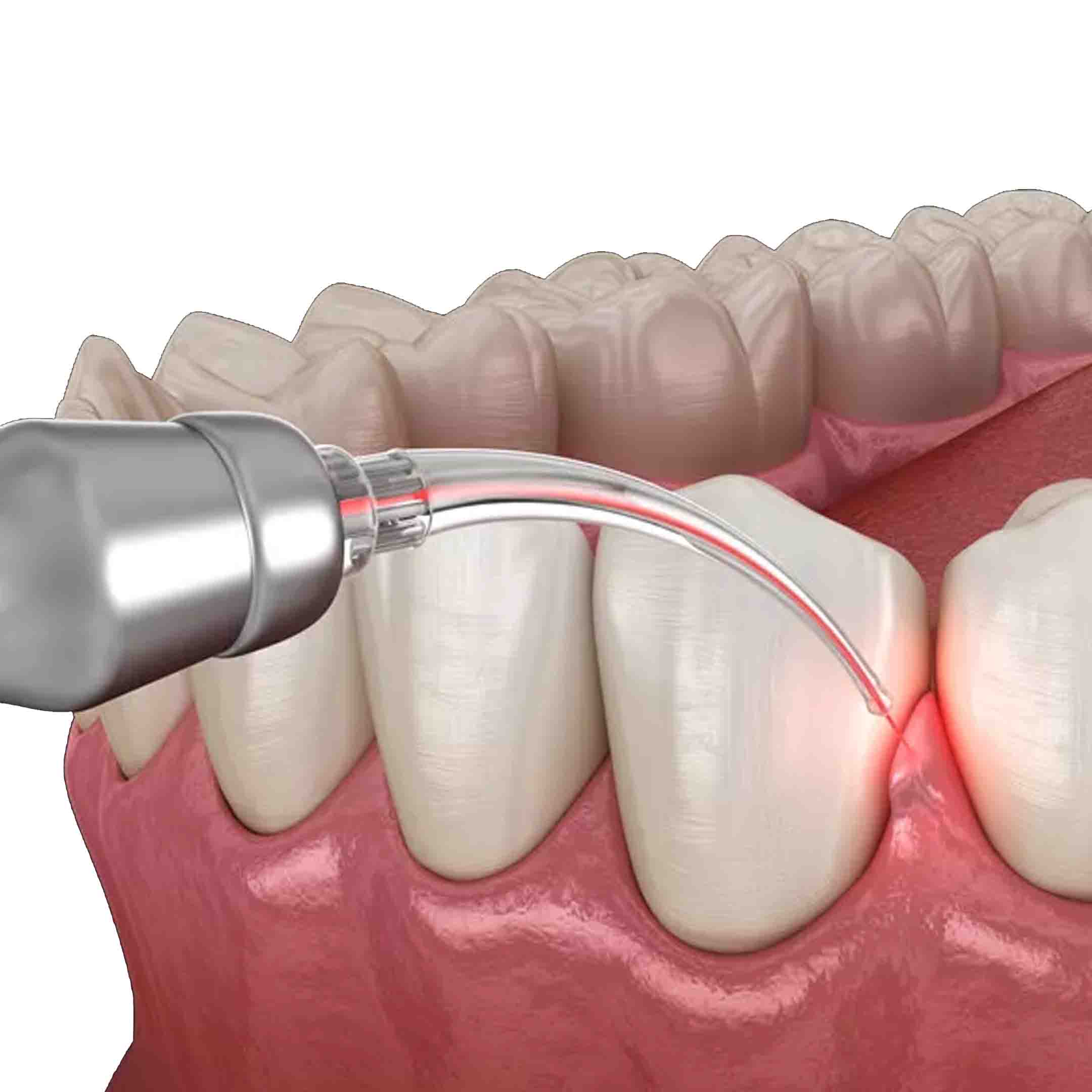 laser treatment for gums