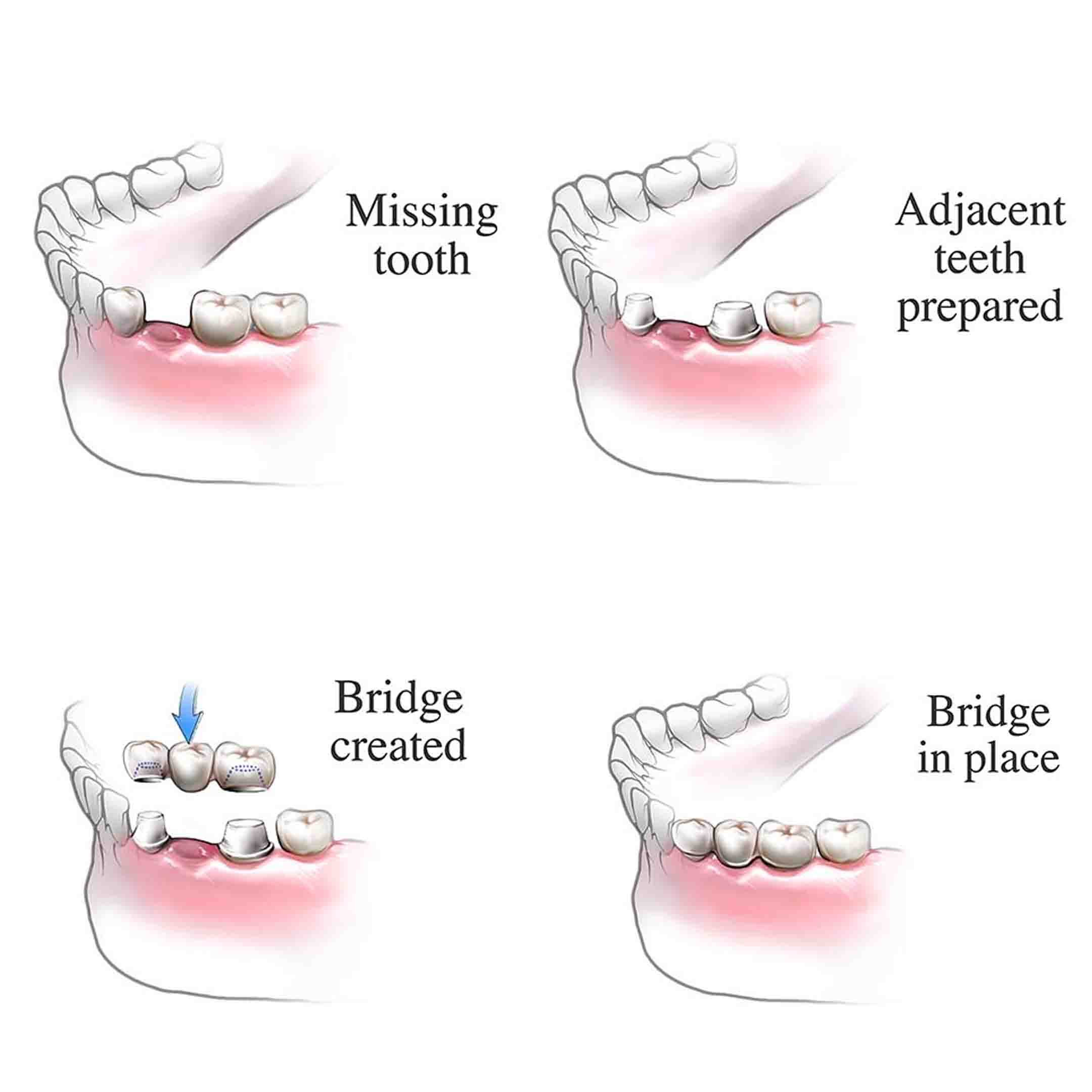 procedure for dental bridge