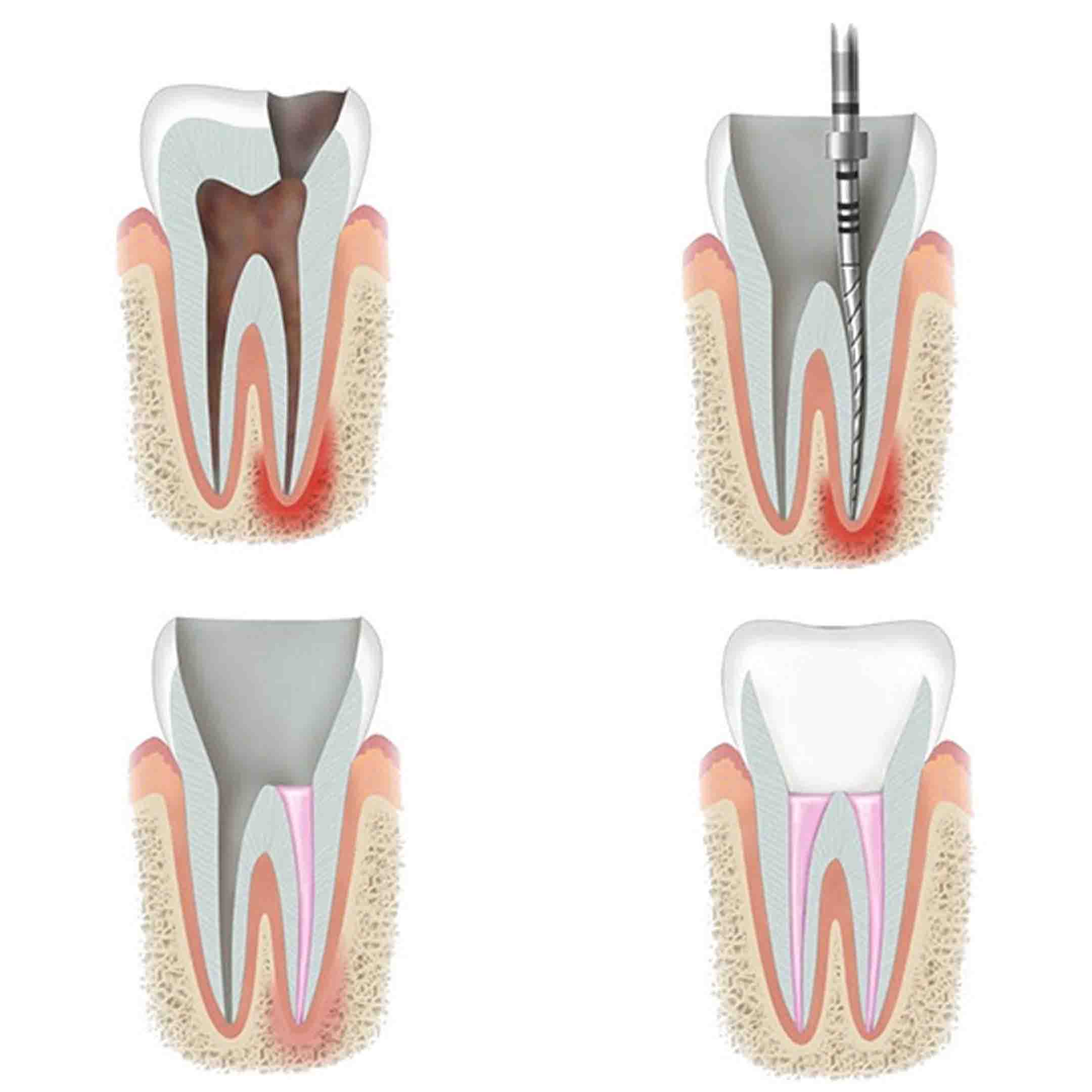 root canal procedure
