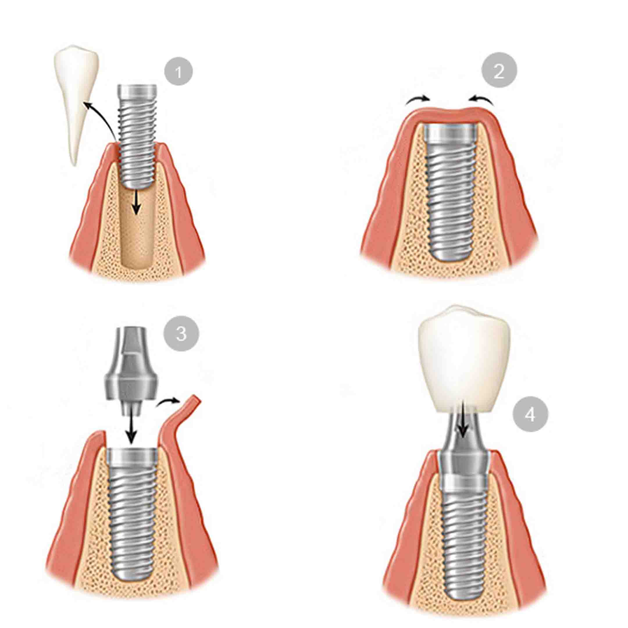stages of a tooth implant