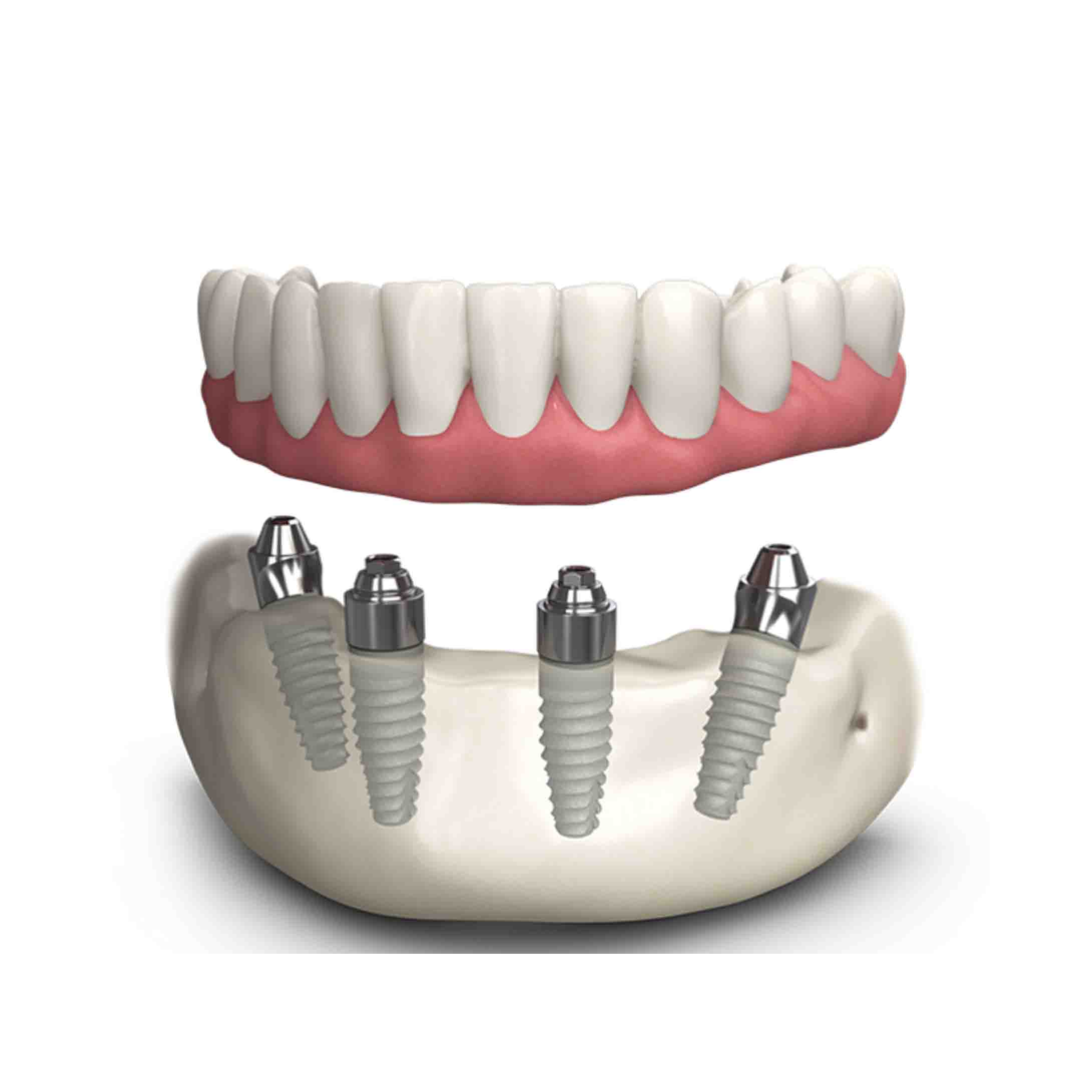 TeethXpress Dental Implants
