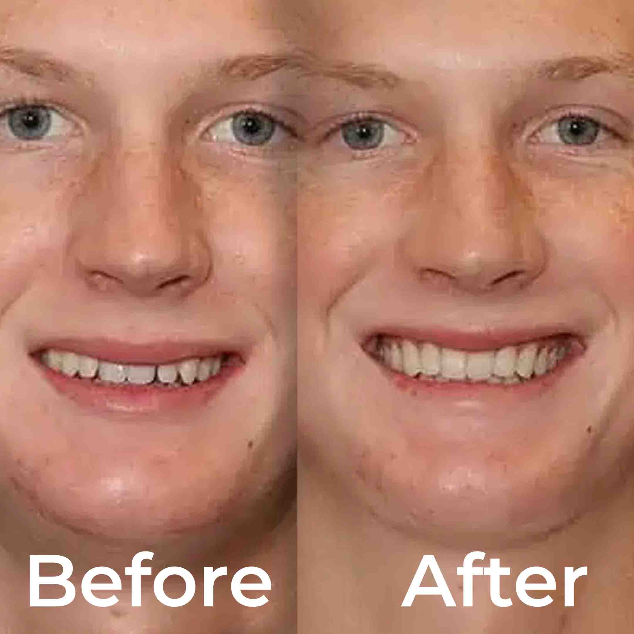 tooth bonding before and after
