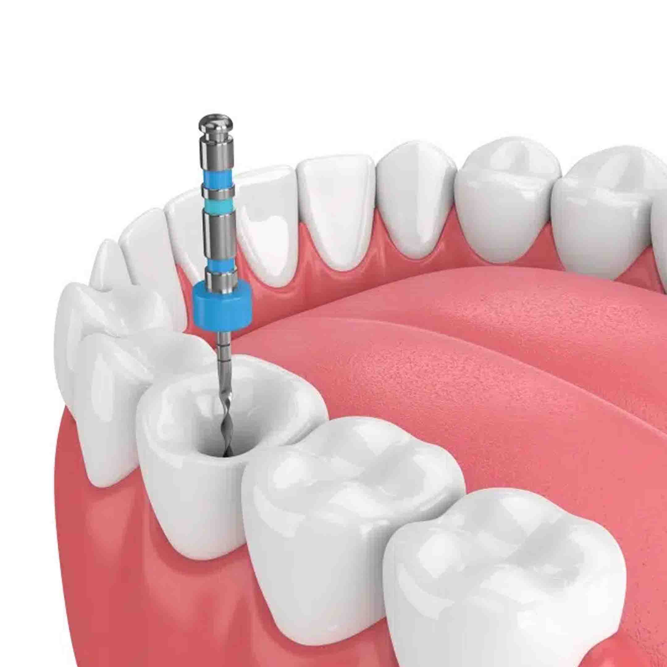 what are the risks of root canal