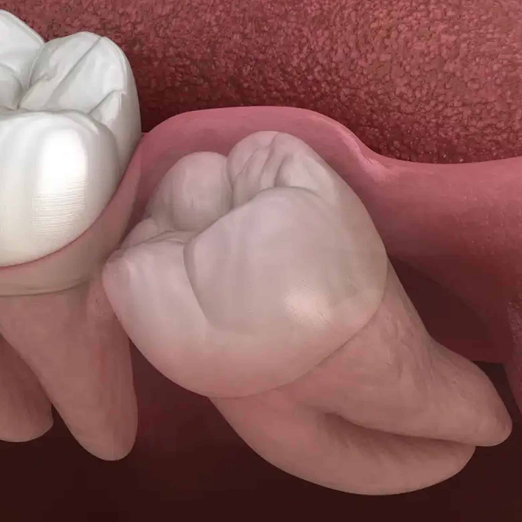 what are the side effects of tooth extraction