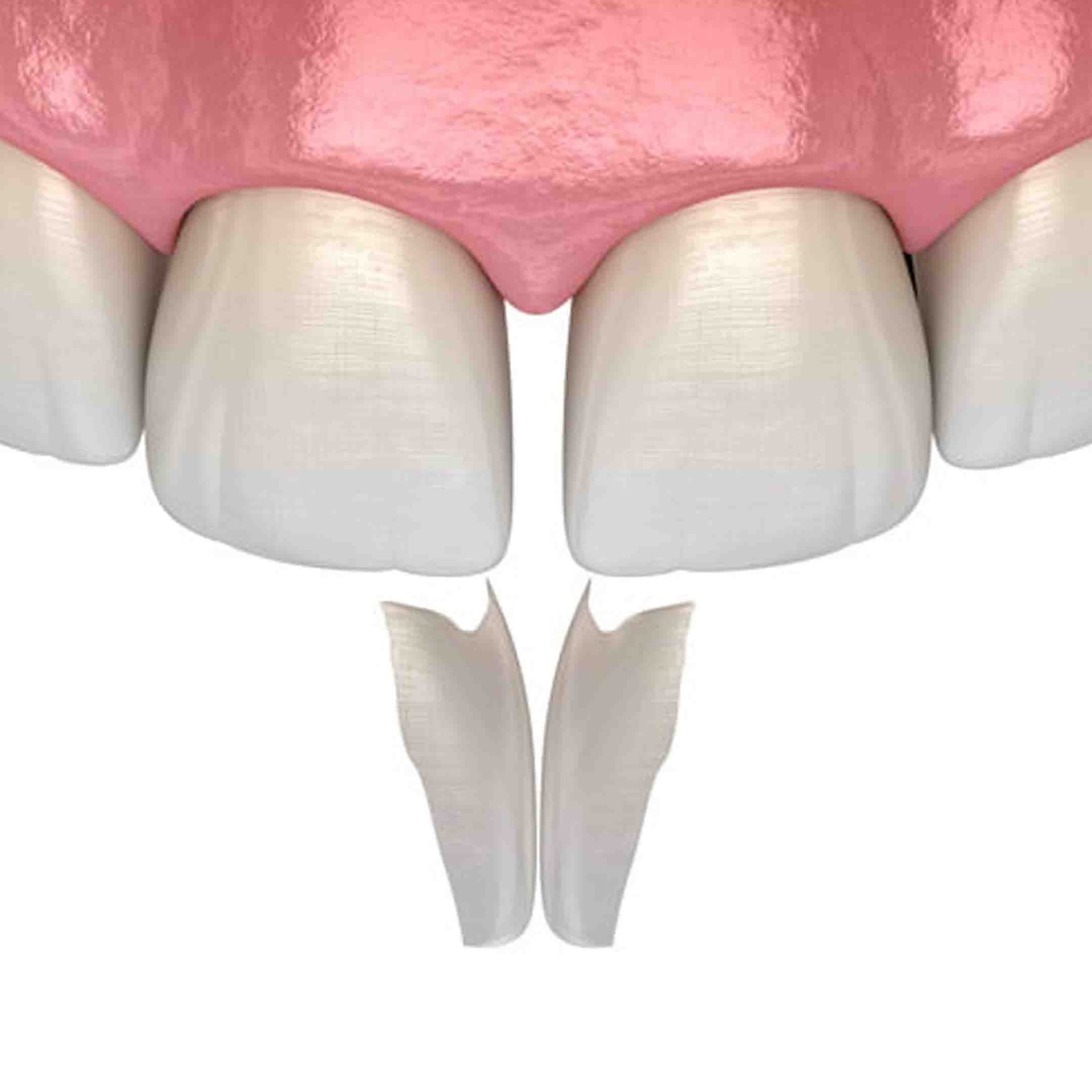 Dental Bonding Fresno, CA