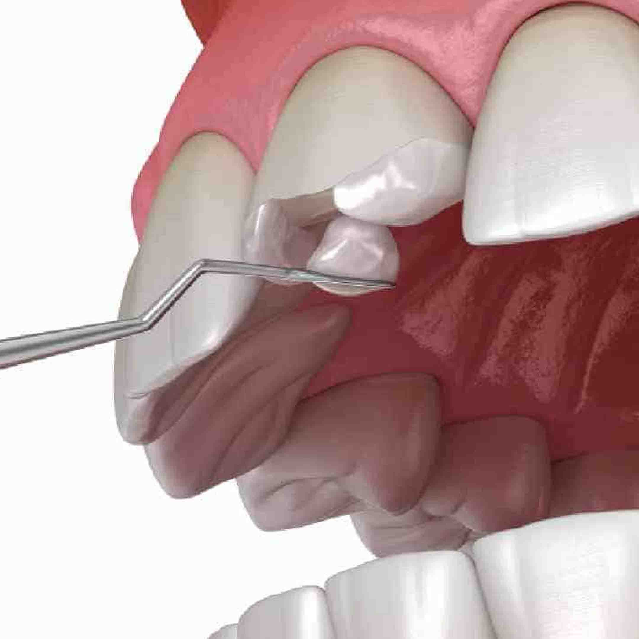 what is the purpose of a dental bonding