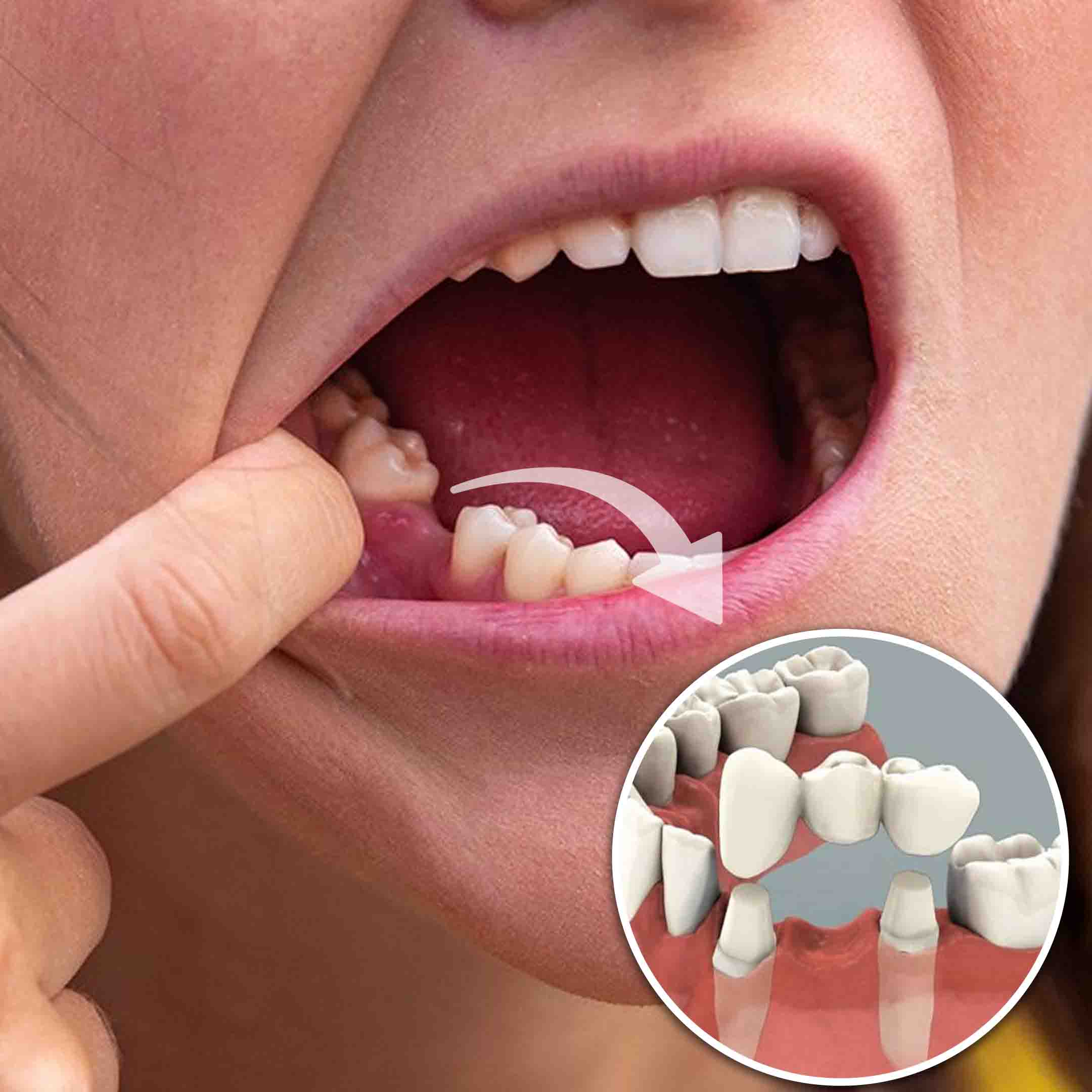 when is a dental bridge needed