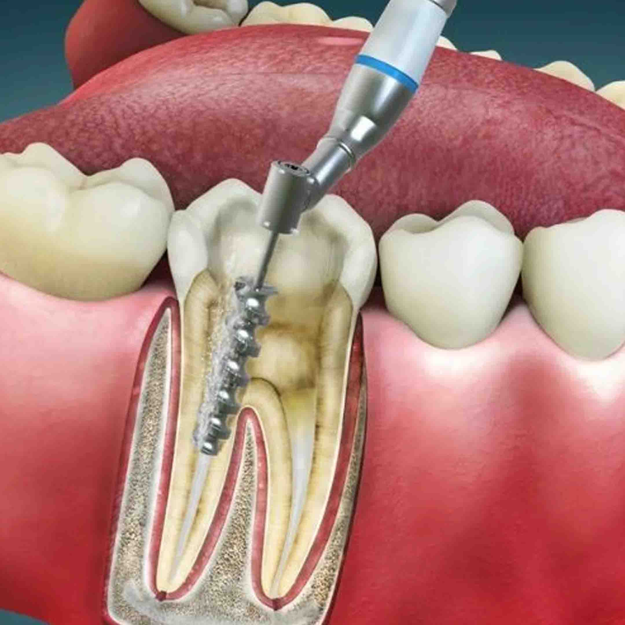 when is a root canal needed