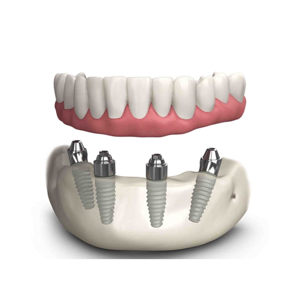 TeethXpress Dental Implants