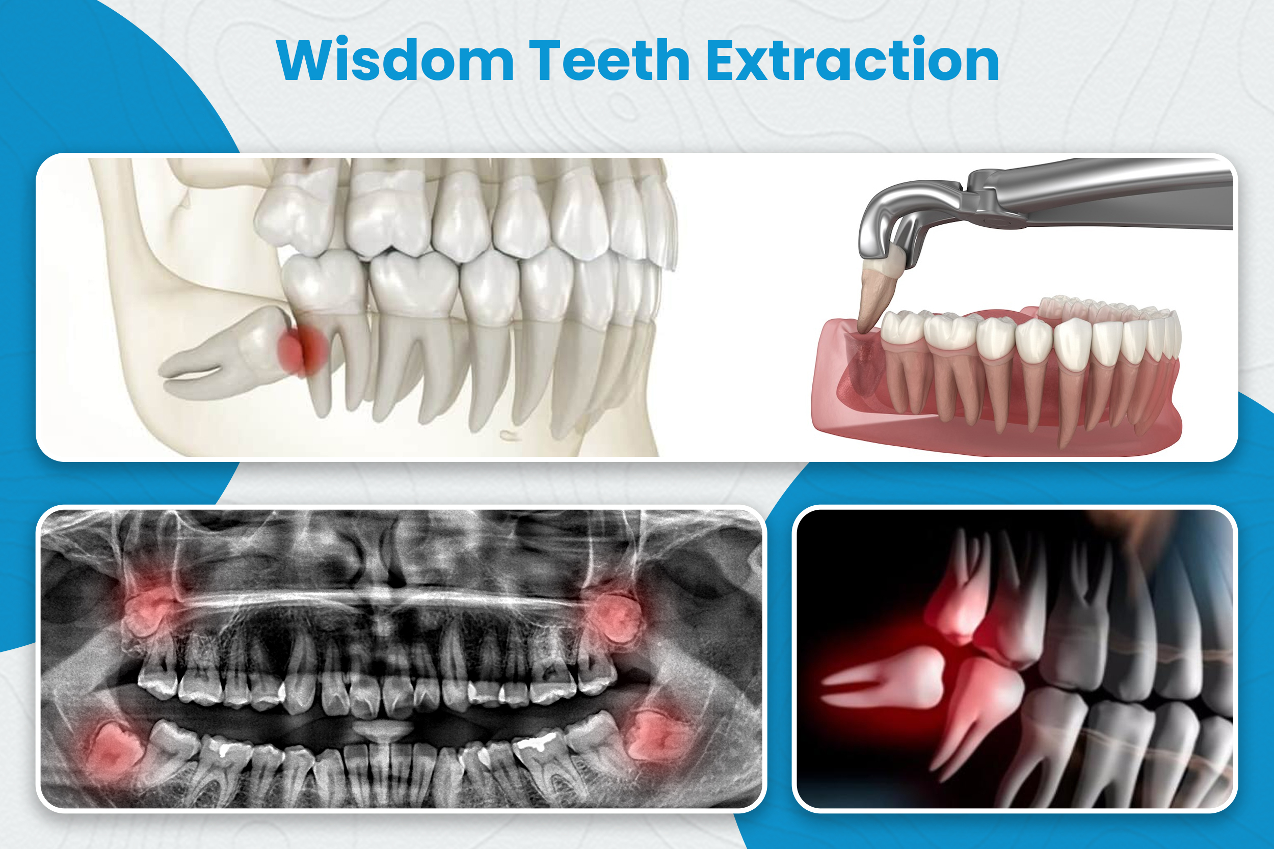Wisdom Teeth Extraction